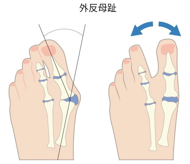 外反母趾イメージ
